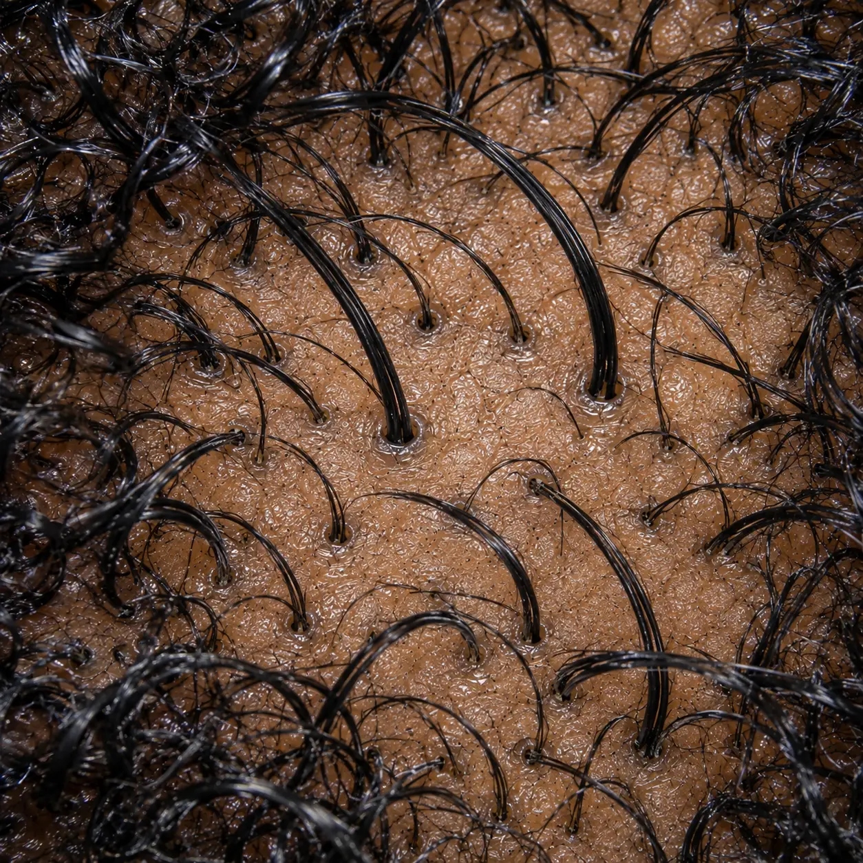 200x close-up of still healthy follicles, full-diameter well-anchored hairs with several hairs per opening