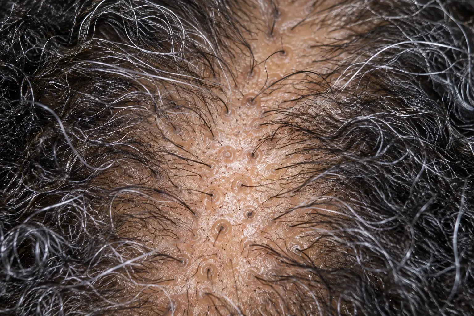 200x view of the scalp showing widely varying hair thickness across the same area