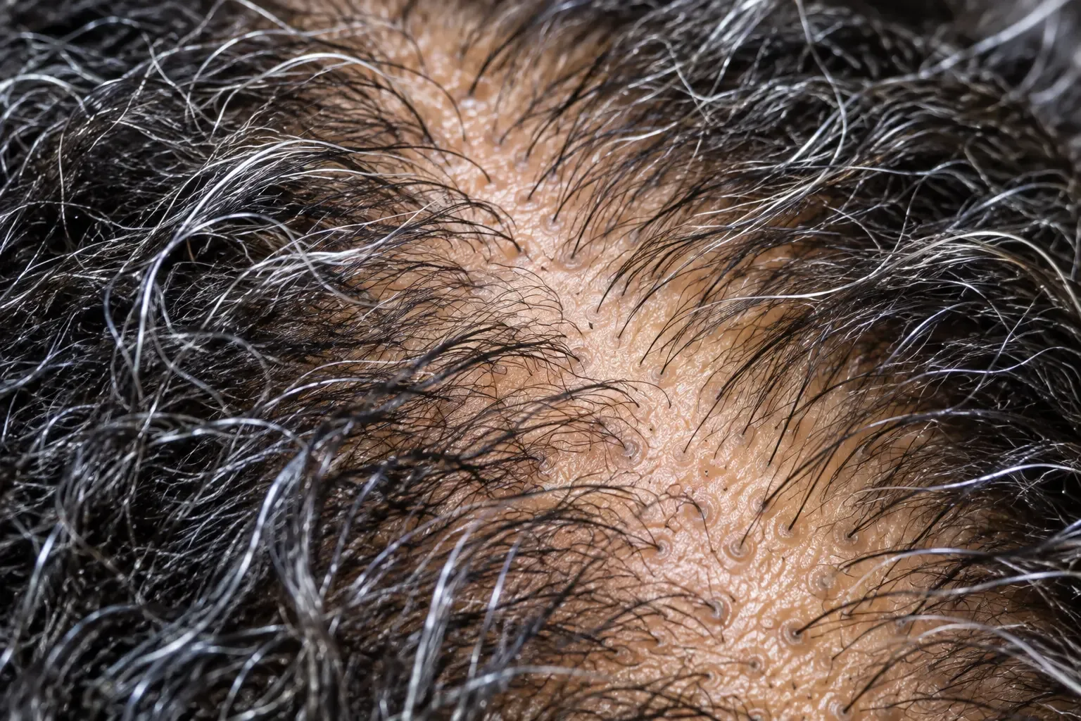 200x view of the scalp right after heavy shedding, follicle openings visible with mostly short regrowing hairs