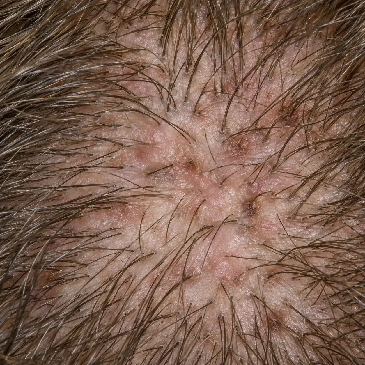 200x close-up of the scalp showing settled redness with small darker spots where bumps have flattened and hairs regrowing through them