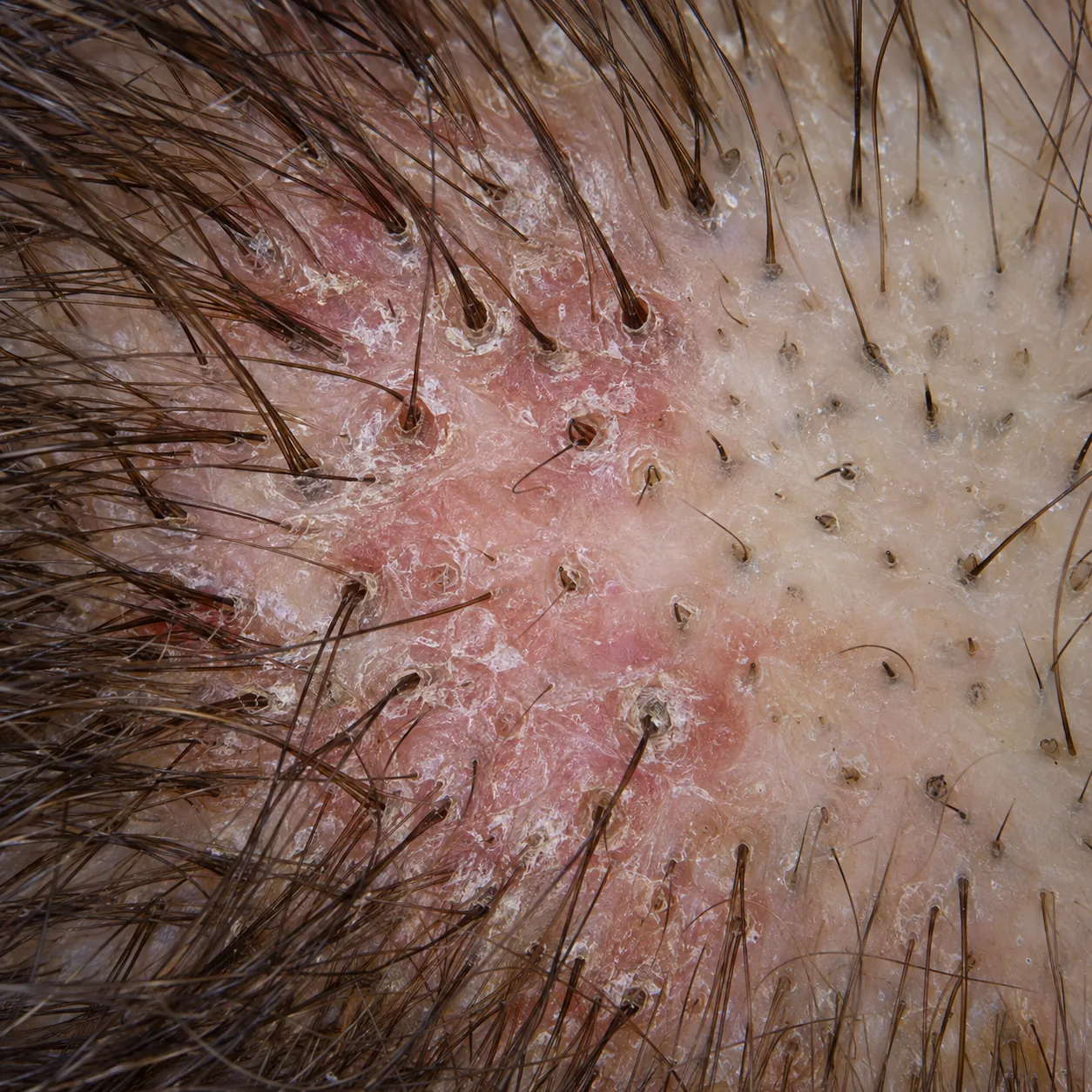 200x view of scale at the base of individual hairs with redness and irregular borders
