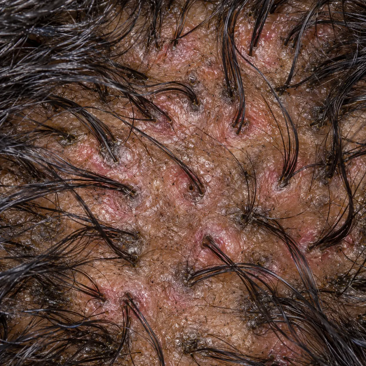 200x scalp view showing redness around follicle openings and scale traveling along hair shafts during a lichen planus evaluation
