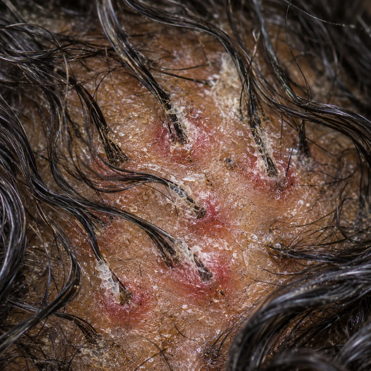 200x scalp view showing redness and scale ringing individual follicle openings during a lichen planus evaluation