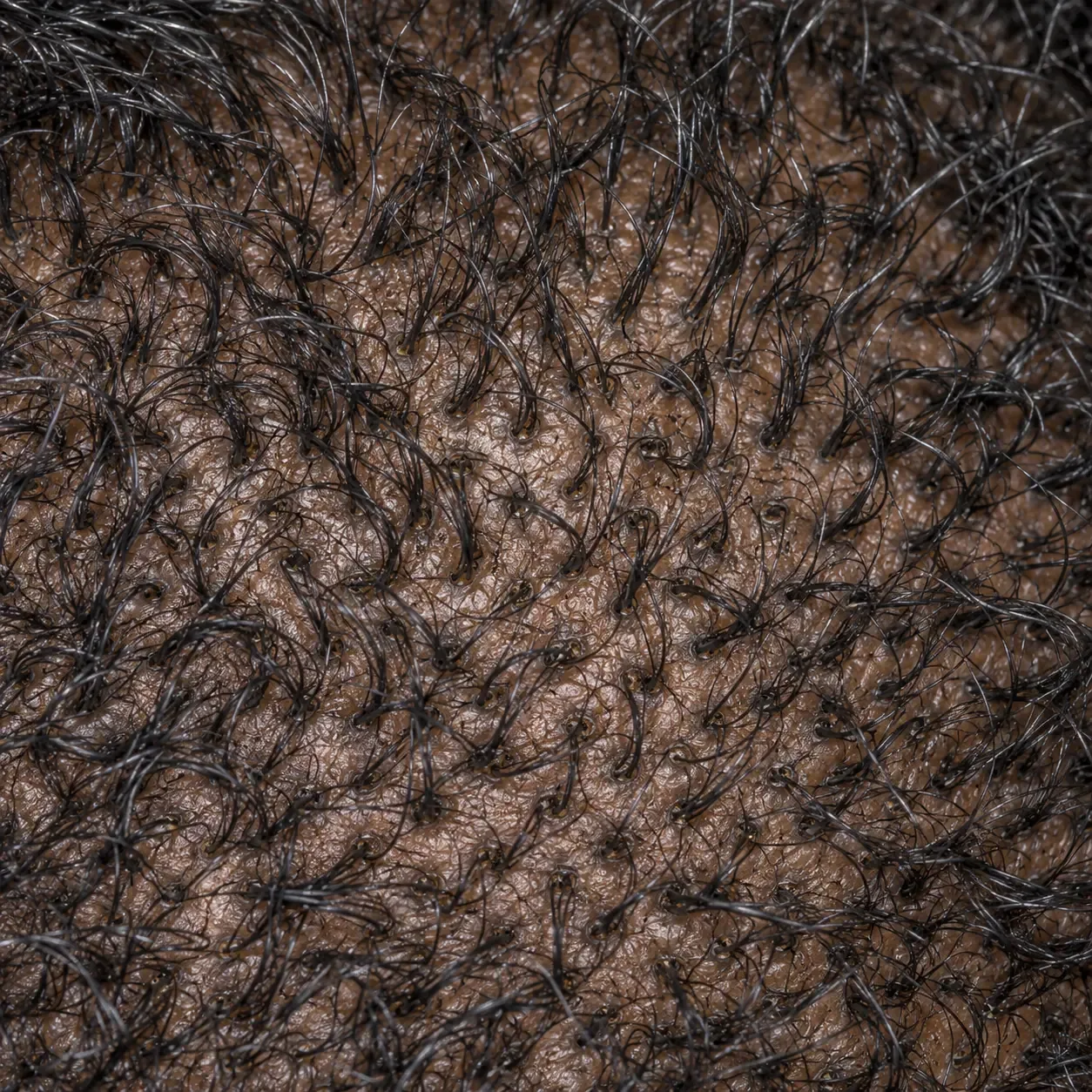 200x view of the occipital donor zone in male pattern thinning, with dense full-thickness hairs evenly packed