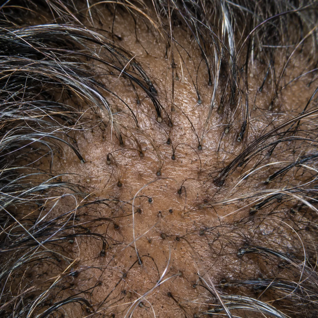 200x view of thicker coarser strands mixed with finer thinned hairs growing from the same area of the scalp