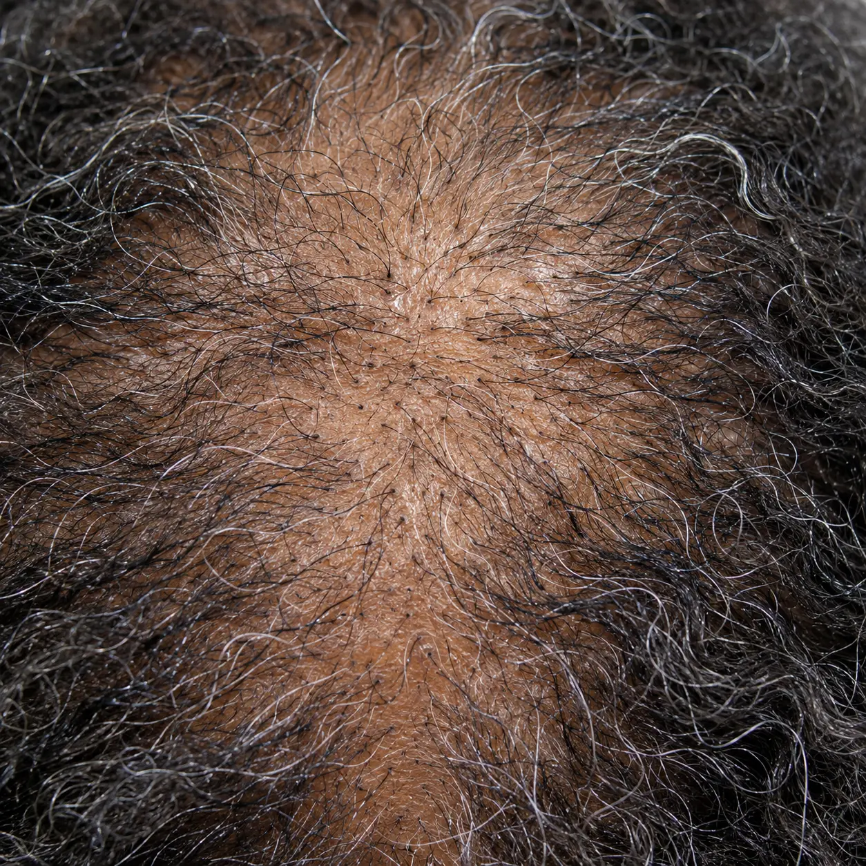 200x view of crown thinning with the hairline intact and finer hairs between full-thickness hairs