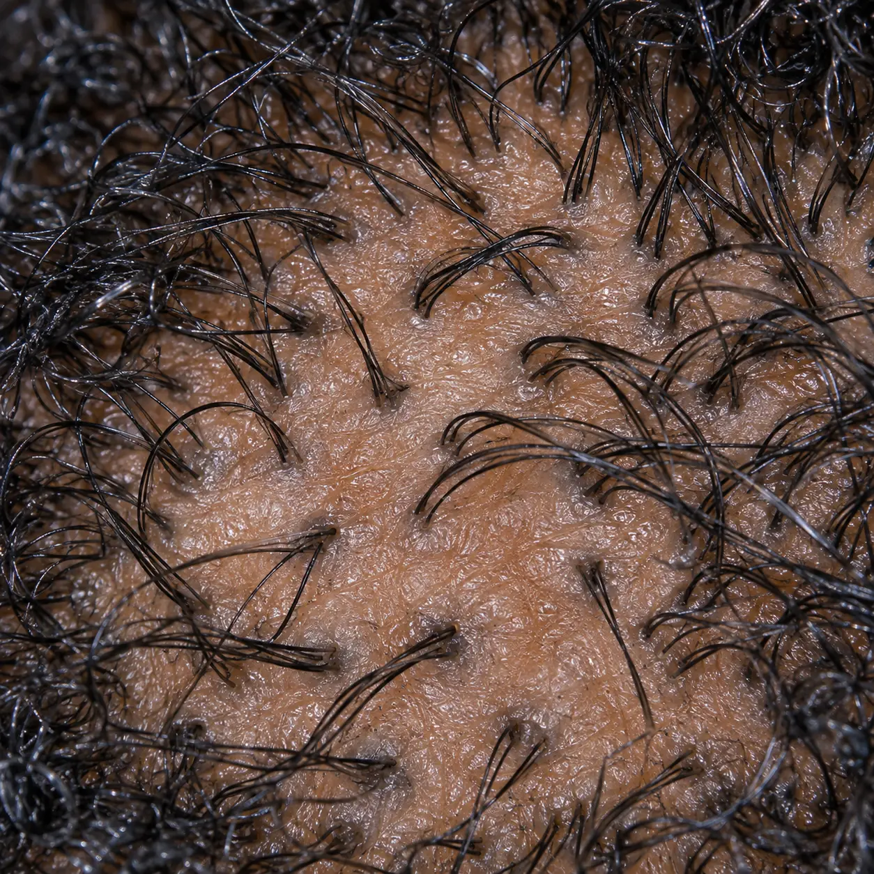 200x close-up showing clean follicle openings, calm skin, and the hairs clearly visible after the scale was cleared