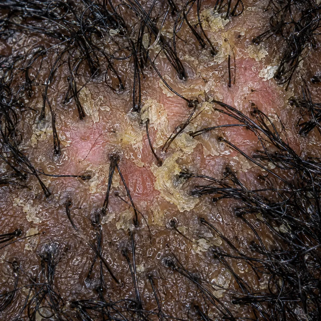 200x close-up of the scalp showing greasy, yellow-tinged flakes stuck to the skin around the hairs, with pink skin underneath