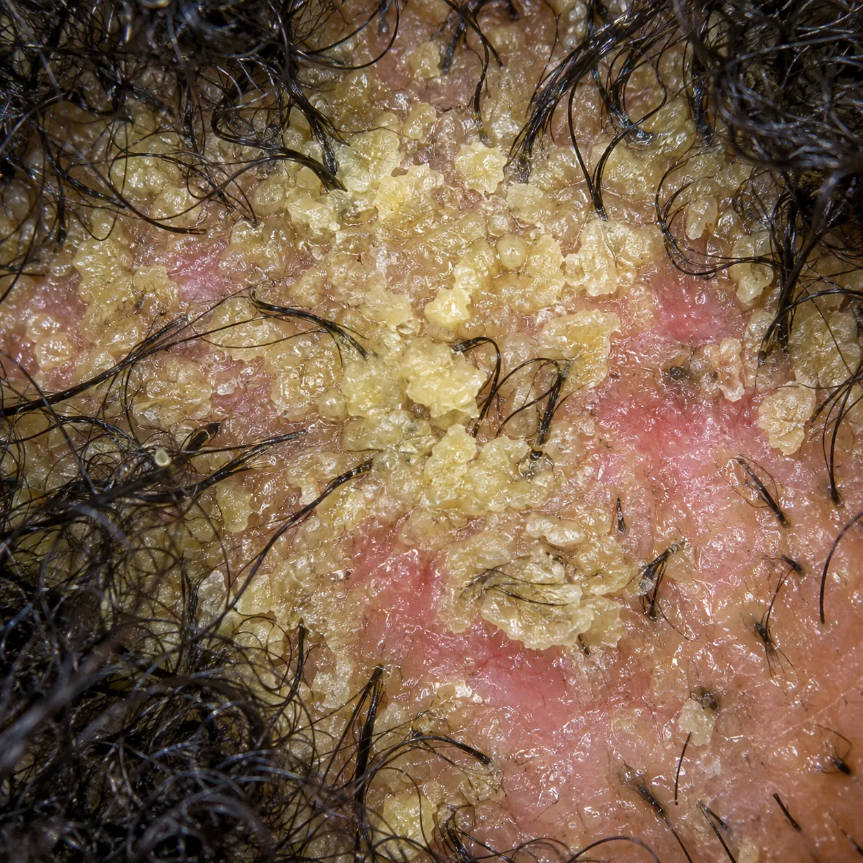 200x close-up showing thick, stuck-on scale covering the follicle openings so the hairs barely show