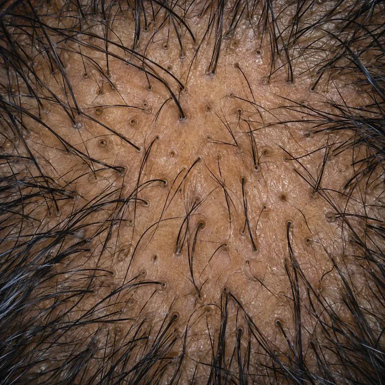 200x scalp view of telogen effluvium with diffuse shedding, resting hairs and newly empty follicle openings spread evenly across the scalp