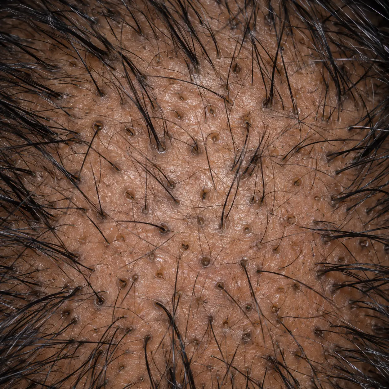 200x scalp view of even telogen effluvium shedding, resting hairs and empty follicle openings scattered uniformly across the scalp