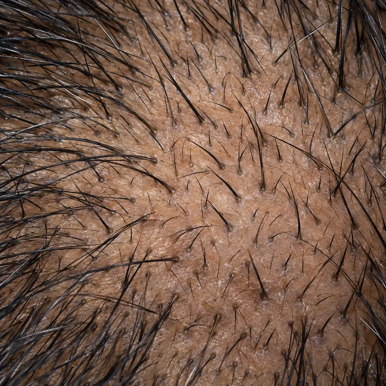 200x scalp view of telogen effluvium recovery with short, fine new hairs of even thickness emerging across the scalp