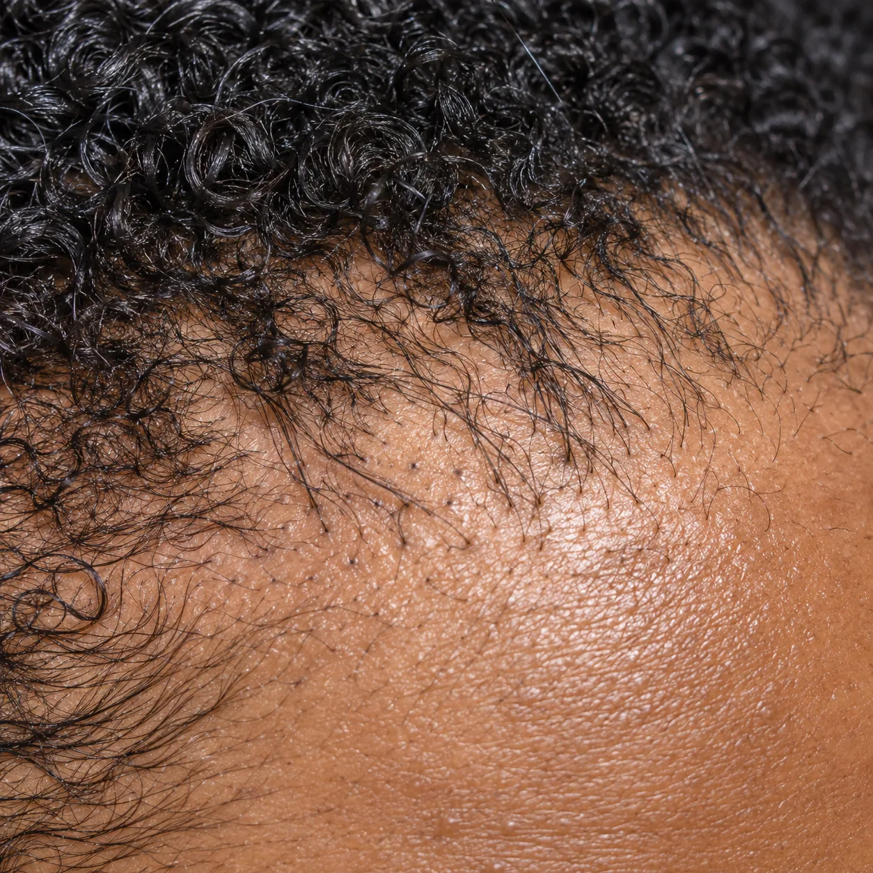200x scalp view of the hairline showing follicular openings and fine retained fringe hairs during a traction alopecia evaluation