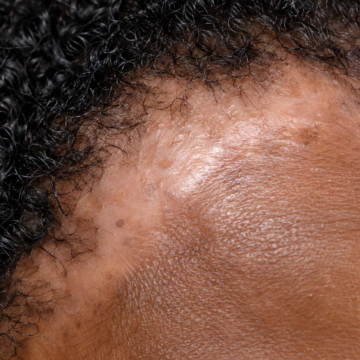 200x scalp view of the hairline showing smooth shiny skin where follicular openings are gone, scarring from traction alopecia