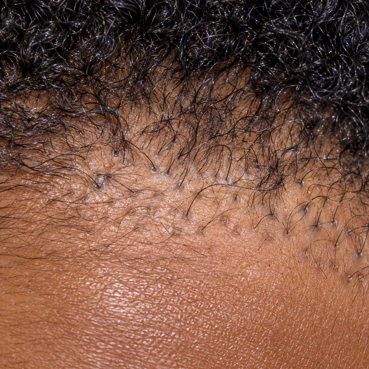 200x scalp view of the hairline showing follicular openings still present with fine regrowth hairs emerging from living follicles