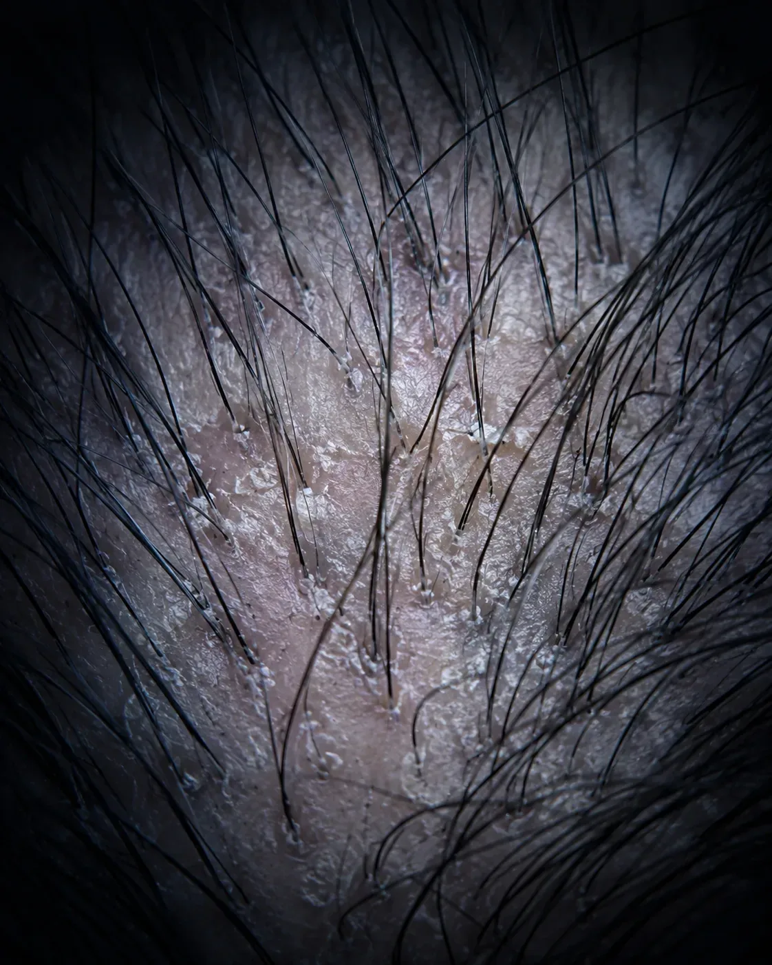 A scalp seen up close under magnification, showing follicles and fine flaking between hairs.