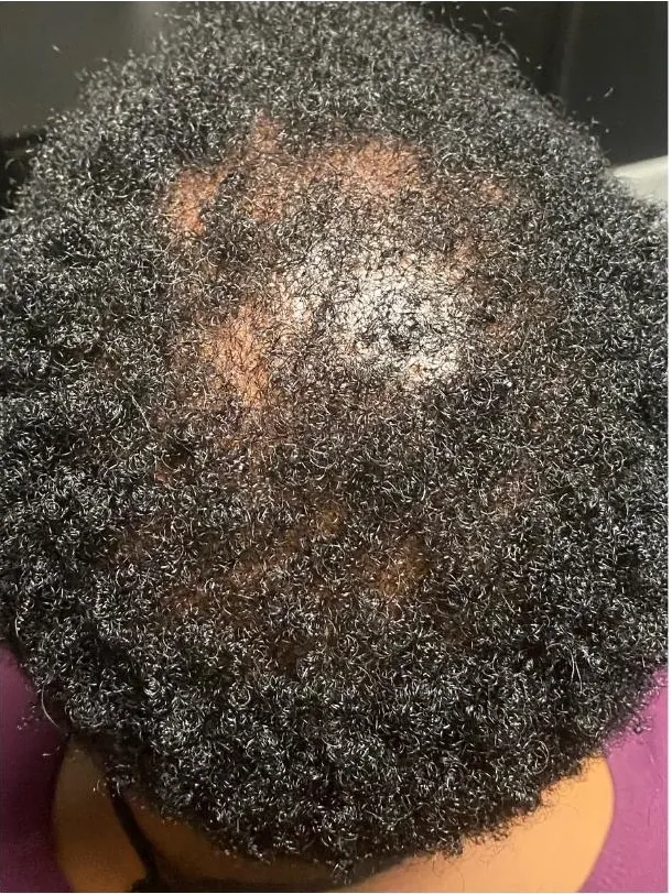 Client's crown eight weeks into her hair restoration plan