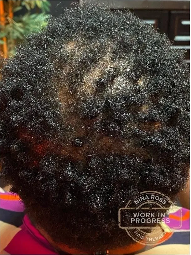Client's crown twenty-six weeks into her hair restoration plan