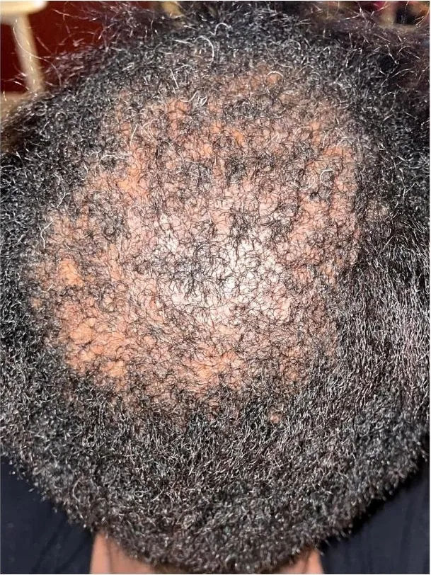Client's crown before beginning her hair restoration plan
