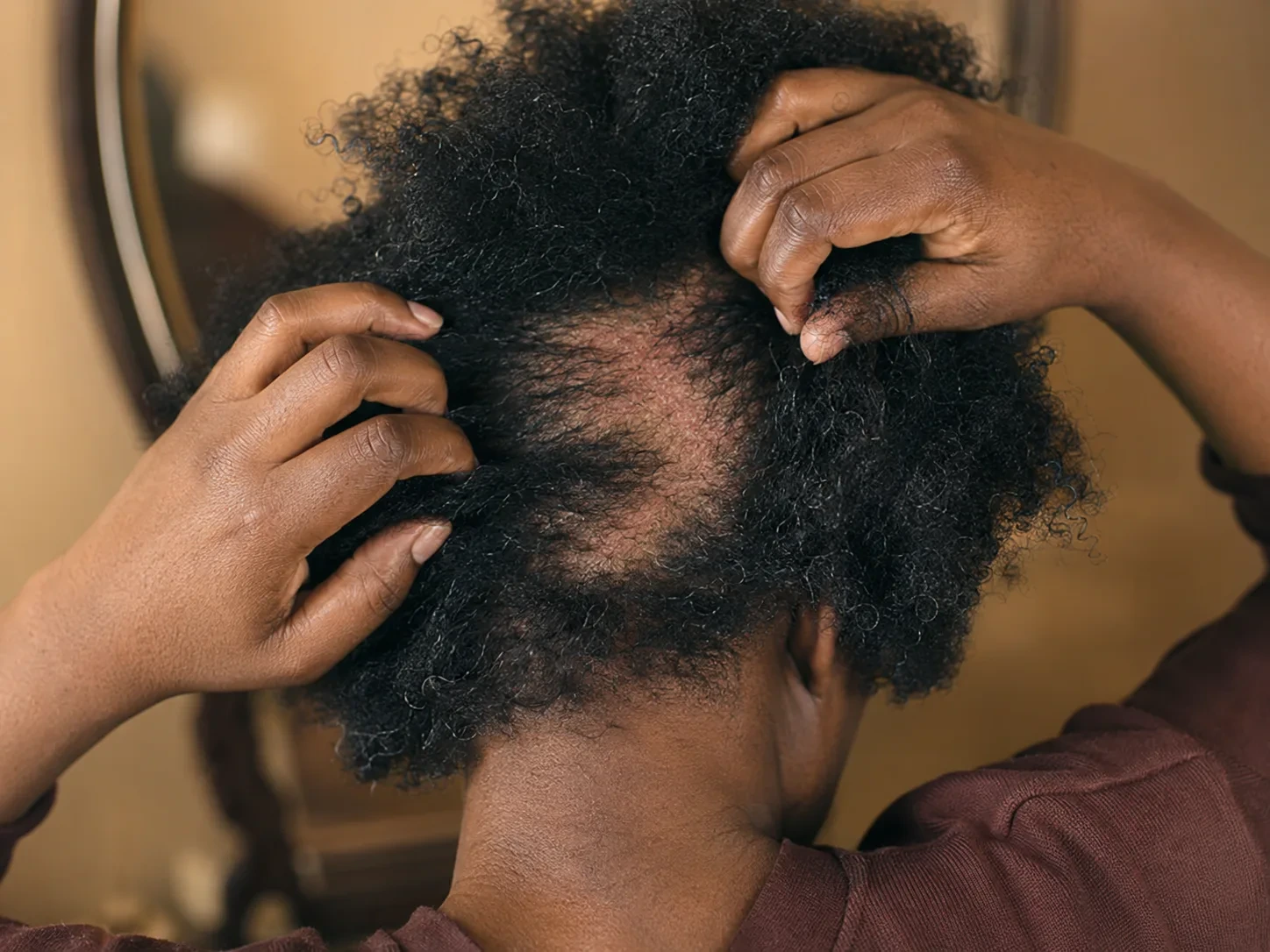View from behind of a person parting their hair to reveal a patch where growth has stalled at the crown