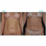 Operation Summer 2026: Ranking of treatments to eliminate localized fat cover