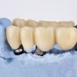 Best ceramic and porcelain dental prosthetics in Cordoba cover