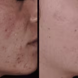 Best clinics for scar subcision in Spain cover