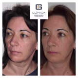 Non-surgical facial rejuvenation clinics in Madrid cover