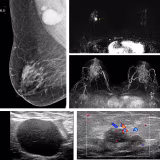 Best breast cancer early detection centers cover