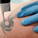 Centros especializados en eliminación de tatuajes con láser de rubí cover