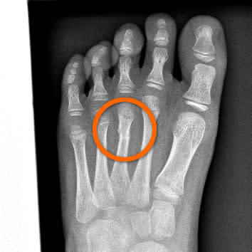 hidden fracture in an x-ray