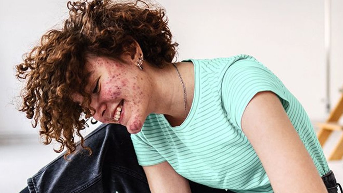 Seven Common Misdiagnoses Linked to Hidradenitis Suppurativa Seven Common Misdiagnoses Linked to Hidradenitis Suppurativa - hidradenitis suppurativa
