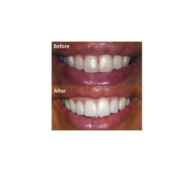 Best dental veneers in San Francisco for a custom smile transformation