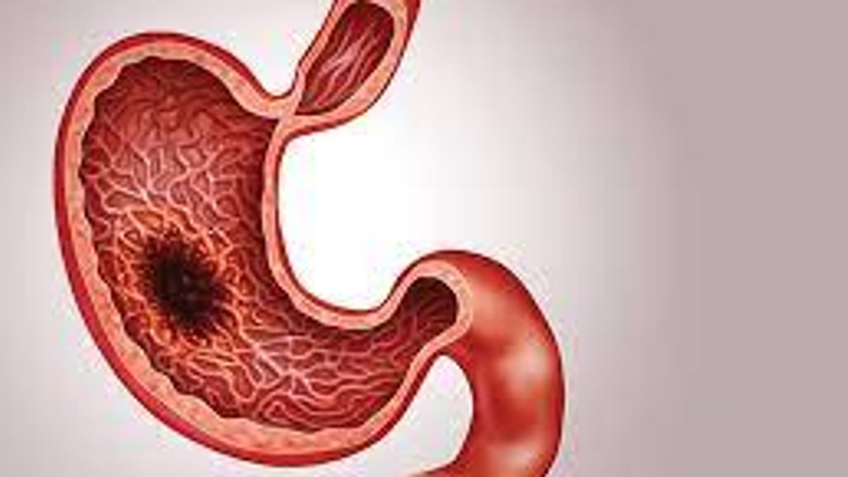 Imfinzi plus chemo improves survival in gastric cancer - imfinzi chemotherapy gastric cancer