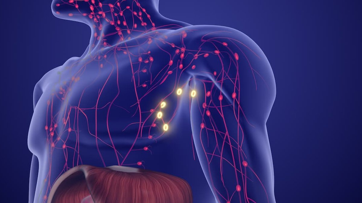 Hidradenitis suppurativa linked to lymphoma risk - hidradenitis suppurativa lymphoma