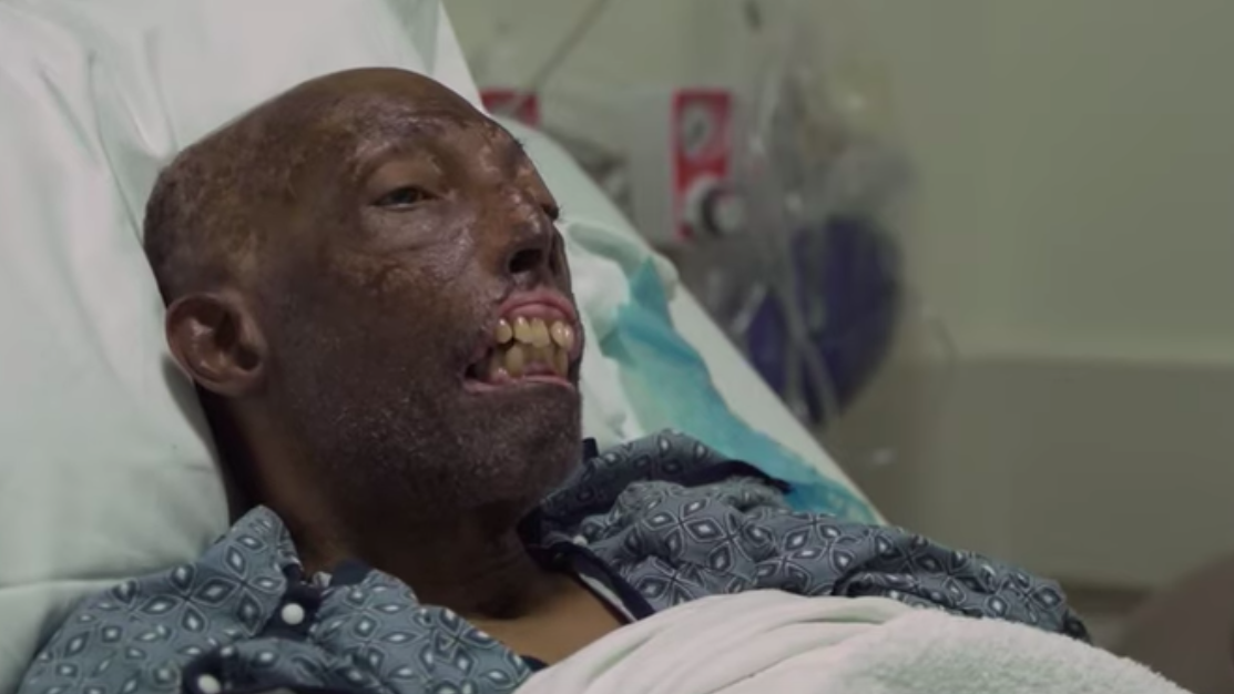 The First Black Man To Receive A Face Transplant Is Also The Oldest To Do So