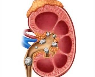 kidney stone