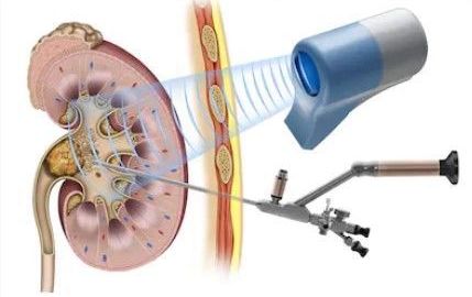 lithotripsy