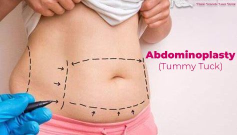 abdominoplasty