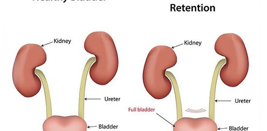 urinary retention