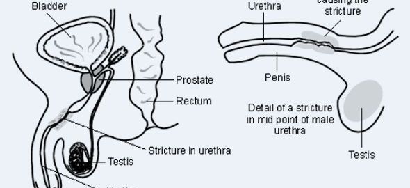Urethral-Stricture