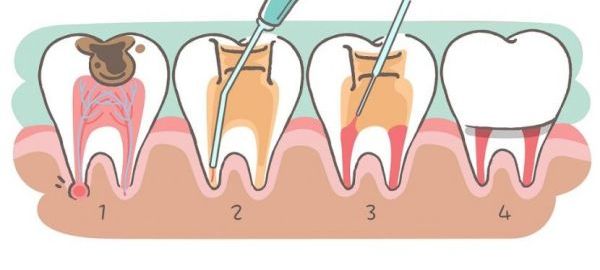 Root Canal Treatment