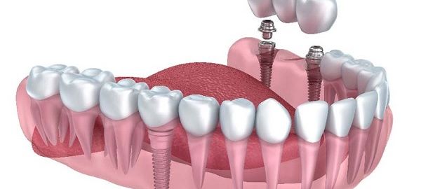 Dental Implant in Pitampura