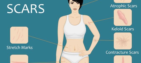 Scar Removal in Delhi