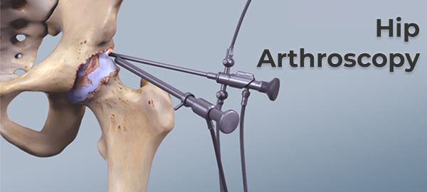 Hip Arthroscopy