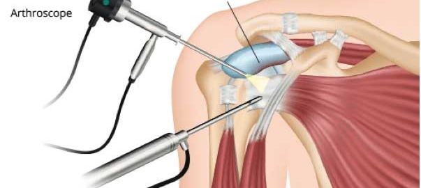 arthroscopy