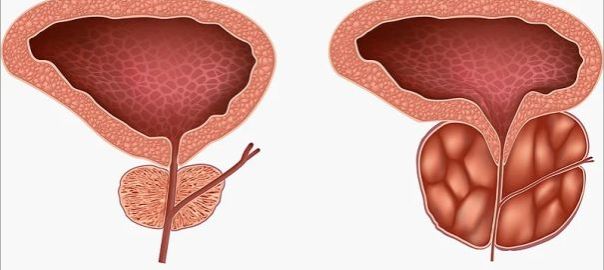 Benign Prostatic Hypertrophy