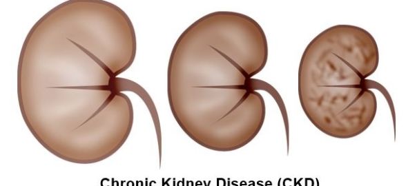 Chronic Kidney Disease