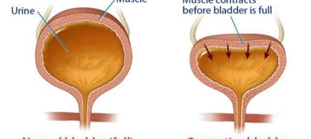 Overactive Bladder