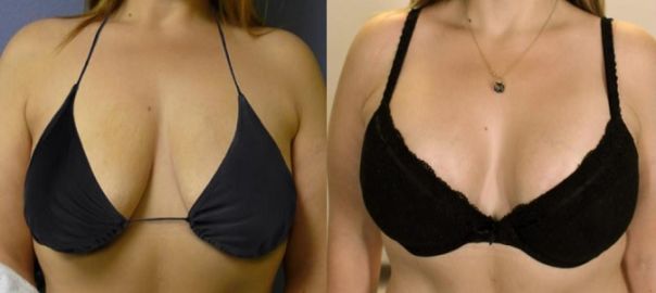 Breast Lift Surgery